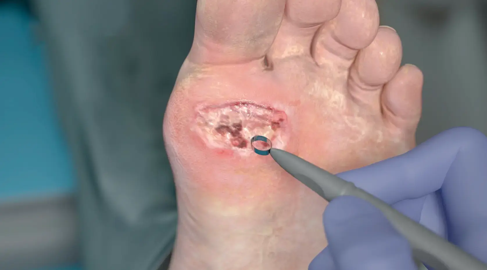 Prepare wound to ensure it is free of debris and necrotic tissue