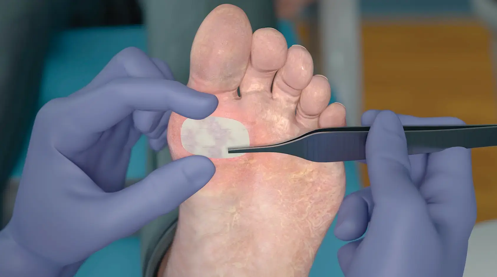 Cut the dry sheet to the appropriate size and place in contact with the wound bed