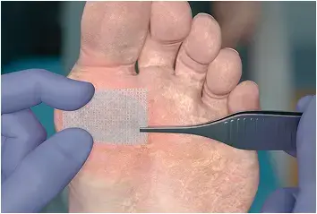 Anchor PuraPly AM or PuraPly XT  using preferred fixation method, such as sutures, adhesive strips, or dermal adhesive and thoroughly cover with a non-adherent dressing